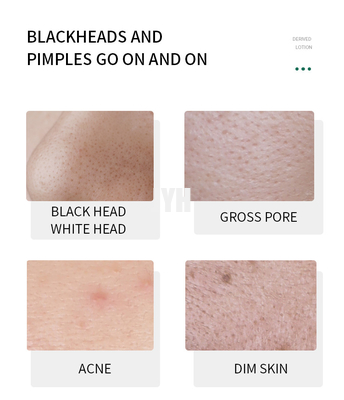 Ablande Lackhead derivó el suero del removedor de la espinilla del suero de la cara de la esencia