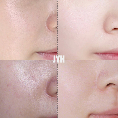 el último tratamiento del acné de la crema del punto 30g aclara y repara la crema de cara